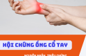 HỘI CHỨNG ỐNG CỔ TAY – NGUYÊN NHÂN, TRIỆU CHỨNG VÀ CÁCH CHĂM SÓC TOÀN DIỆN THEO Y HỌC CỔ TRUYỀN