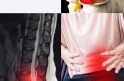 THOÁT VỊ ĐĨA ĐỆM: CÁC DẤU HIỆU NHẬN BIẾT VÀ CÁC PHƯƠNG PHÁP ĐIỀU TRỊ KHÔNG CẦN PHẪU THUẬT