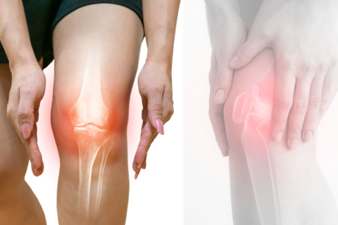 ĐAU KHỚP GỐI: NGUYÊN NHÂN, CÁCH NHẬN BIẾT VÀ PHƯƠNG PHÁP ĐIỀU TRỊ